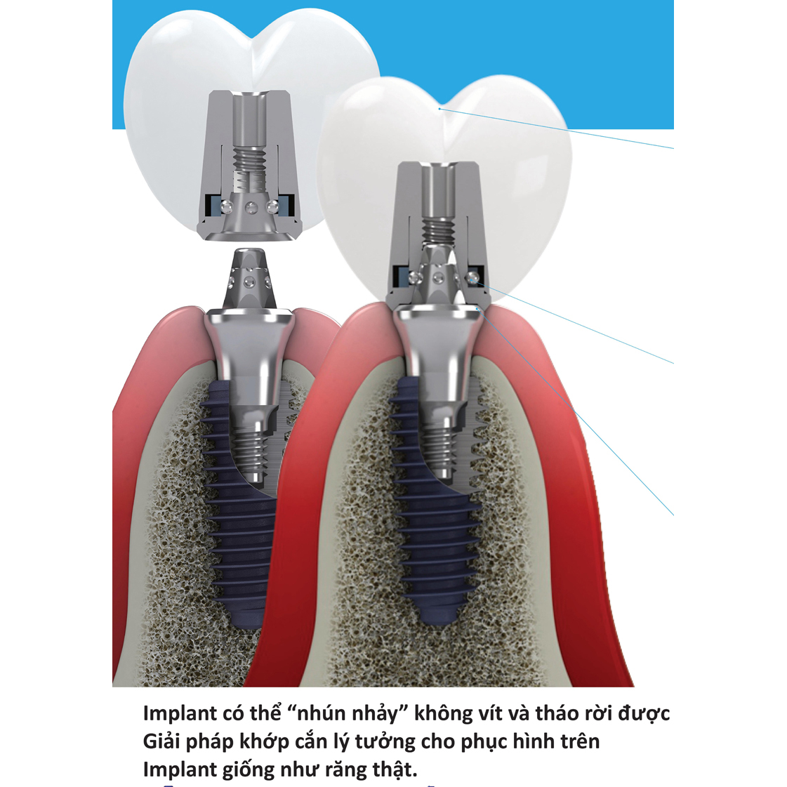 EZ CROWN – PHỤC HÌNH TRÊN IMPLANT KHÔNG LỖ VÍT
