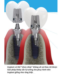 EZ CROWN – PHỤC HÌNH TRÊN IMPLANT KHÔNG LỖ VÍT
